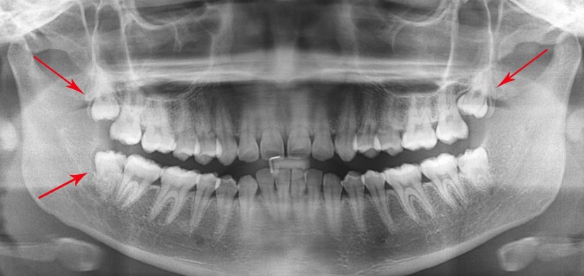 Wisdom-Tooth-Extraction-X-Ray