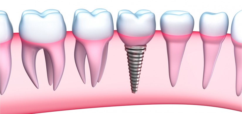 Dental Implants